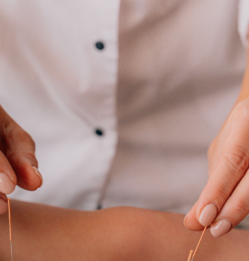 Acupuncture treatment in Central New Jersey for natural pain and allergy relief
