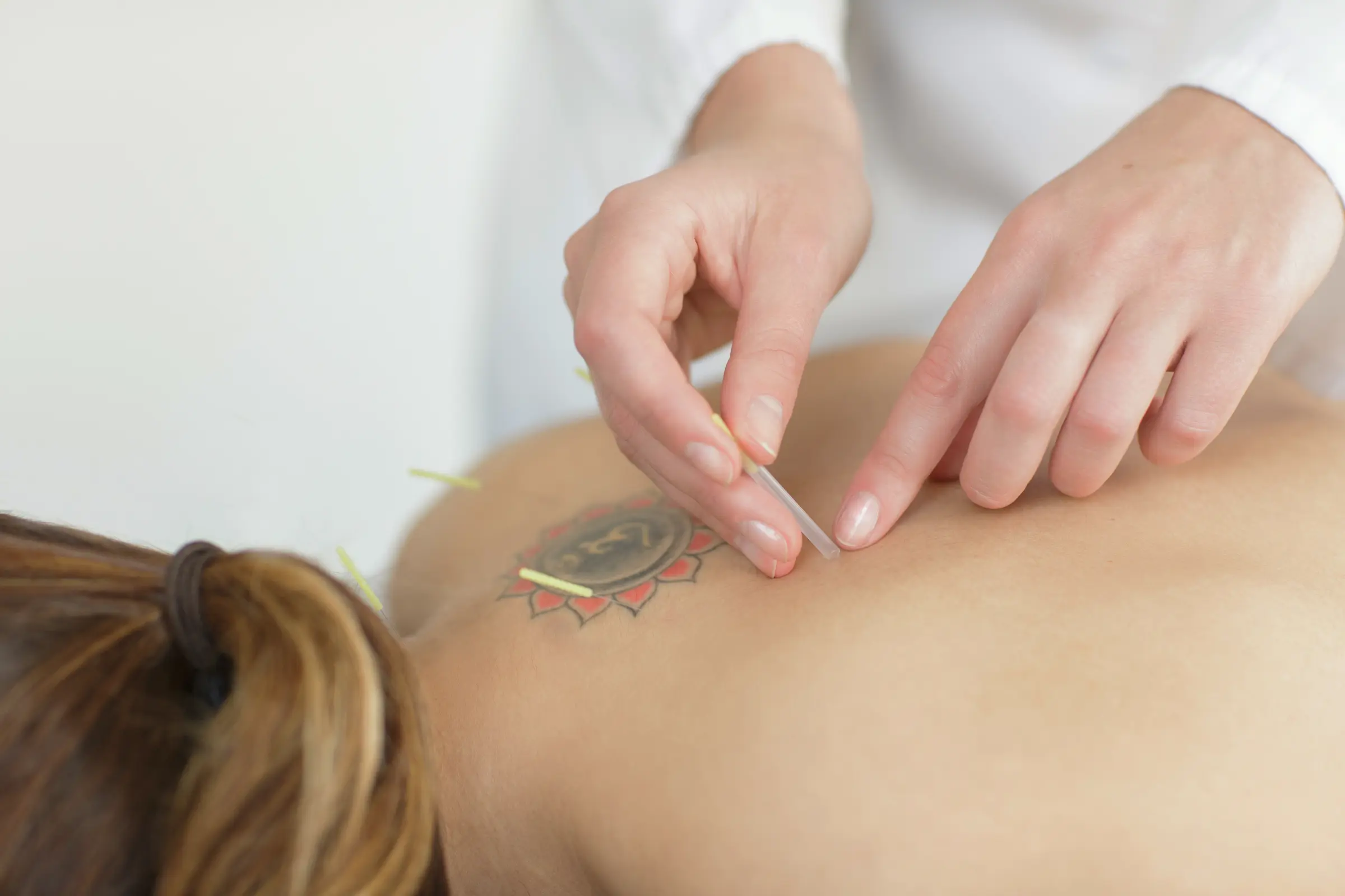 Acupuncture