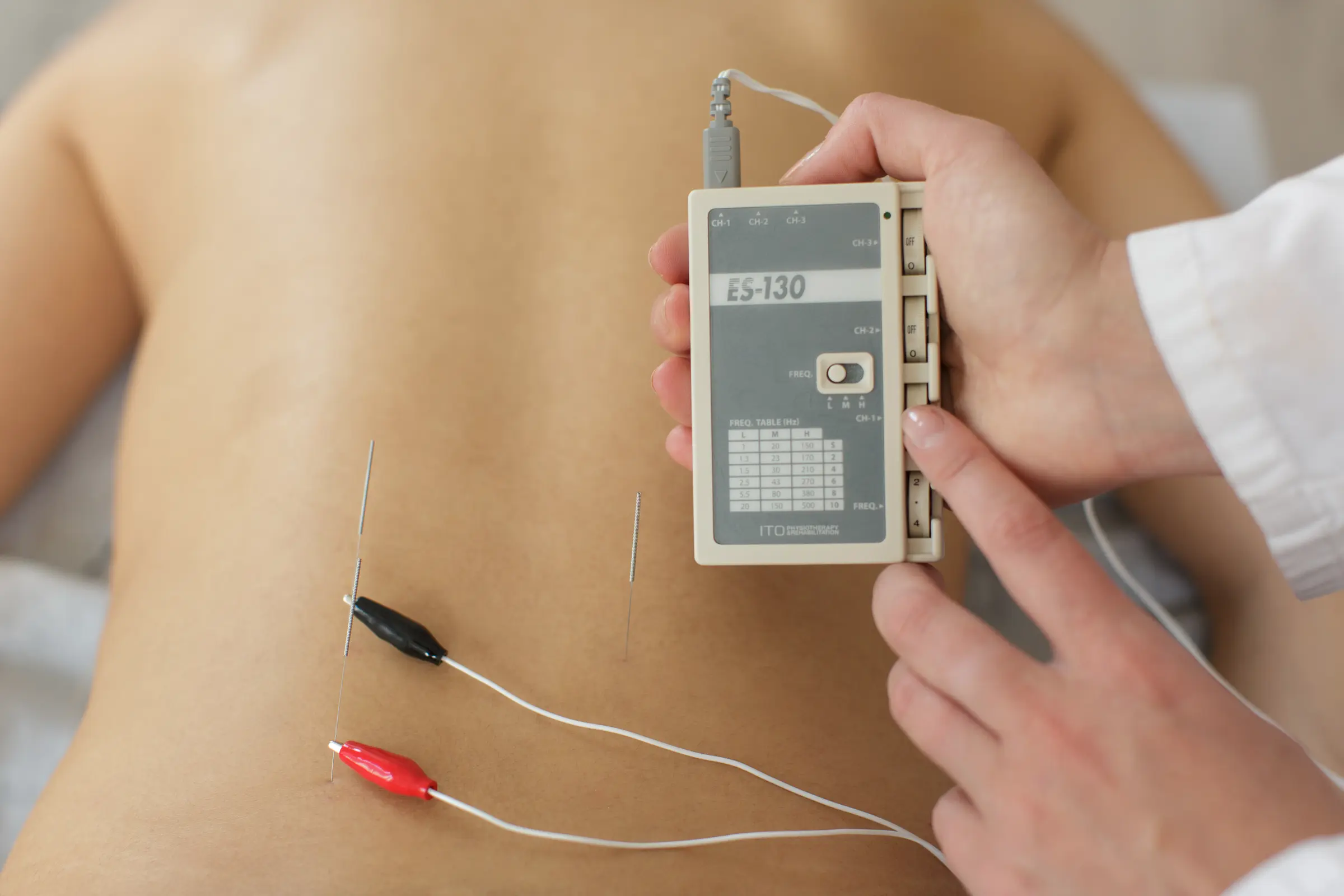 Electro-Acupuncture