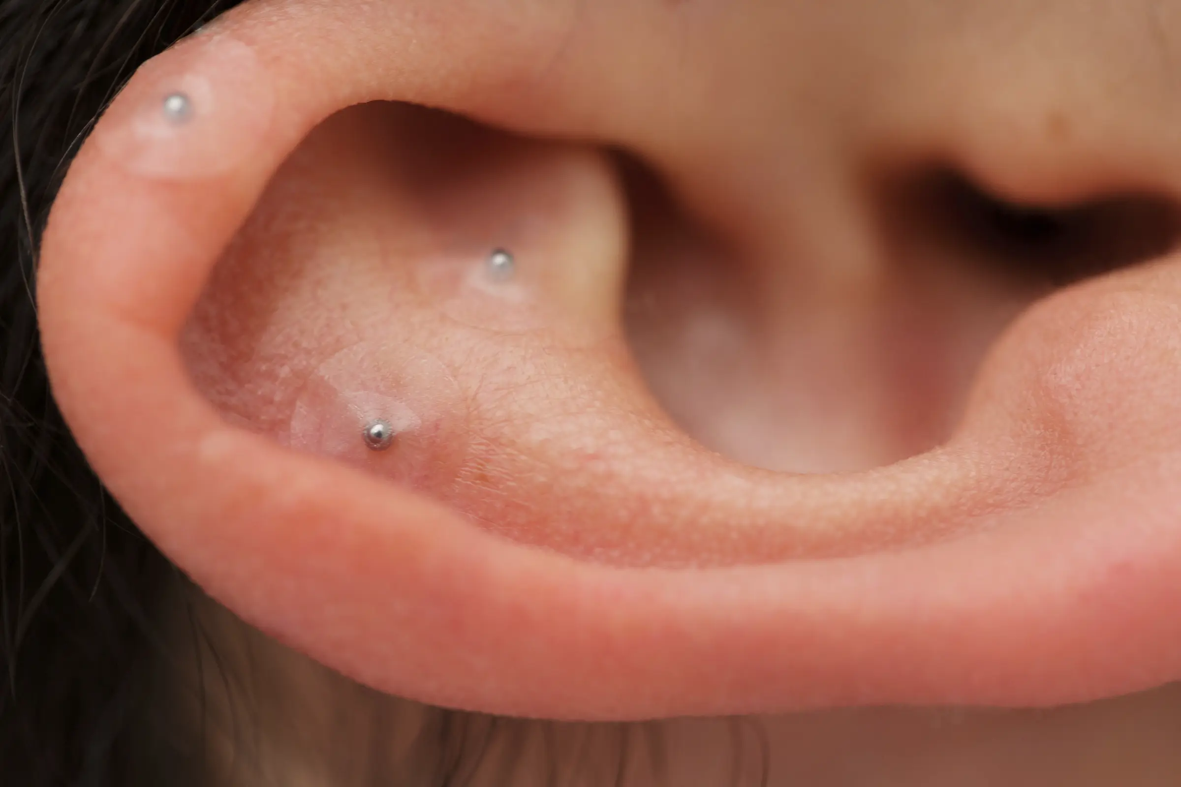 Auricular Acupuncture