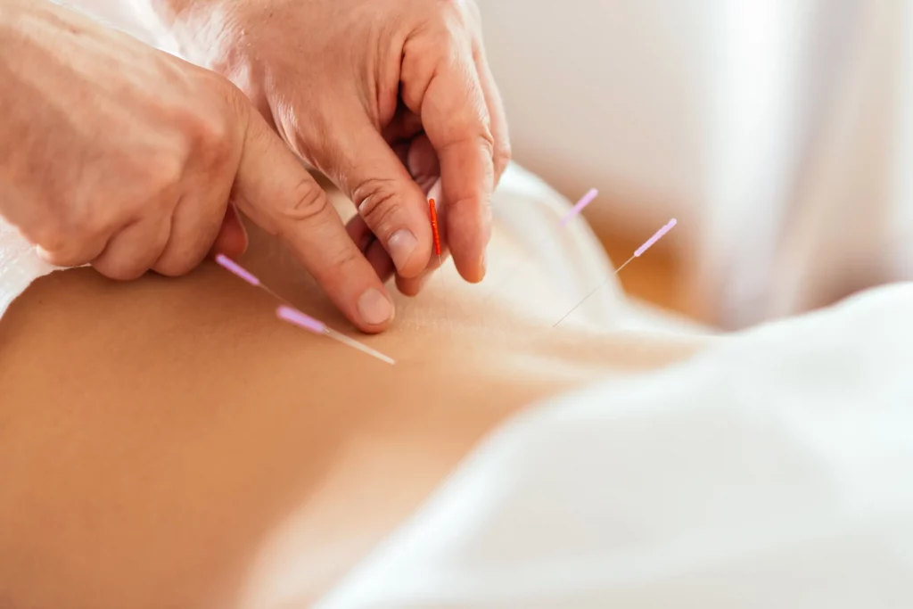 Acupuncture therapy treatment in Freehold NJ for pain relief and wellness