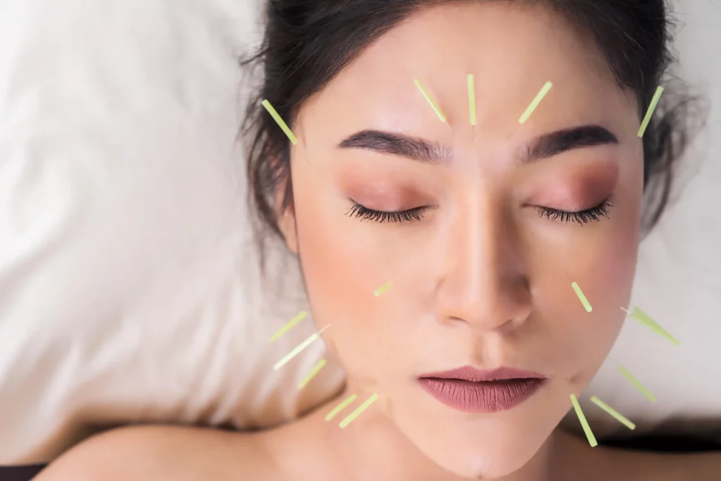 Acupuncture treatment session in Freehold NJ for pain relief and wellness support