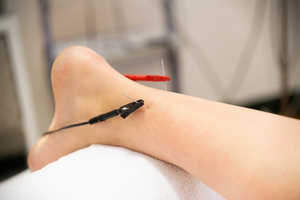 Electro-acupuncture treatment for nerve pain and muscle tension in Freehold NJ